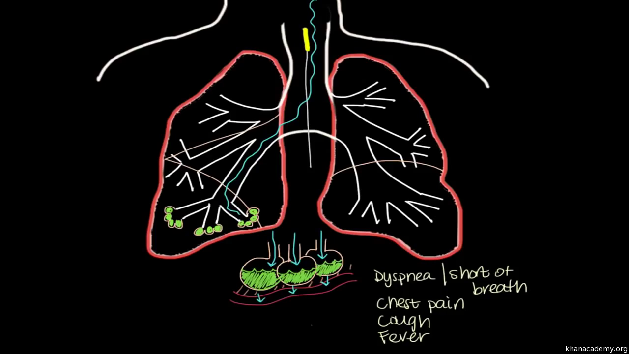 What Is Pneumonia Video Khan Academy
