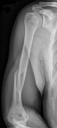 A black and white X-ray image of a person's arm shows the arm bone in white, and the surrounding tissues in lighter gray. The bone is fractured near the elbow.