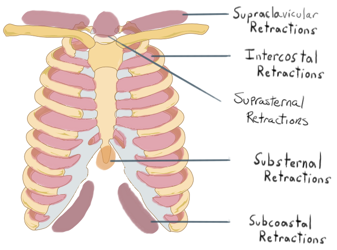 subcostal muscle